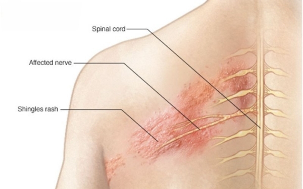 Đau sau Zona: khi nào cần điều trị nội trú?