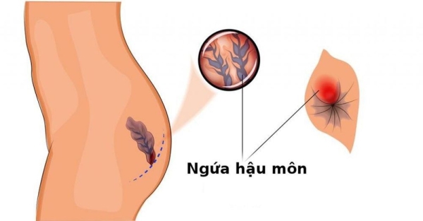 Ngứa hậu môn: Căn nguyên và điều trị