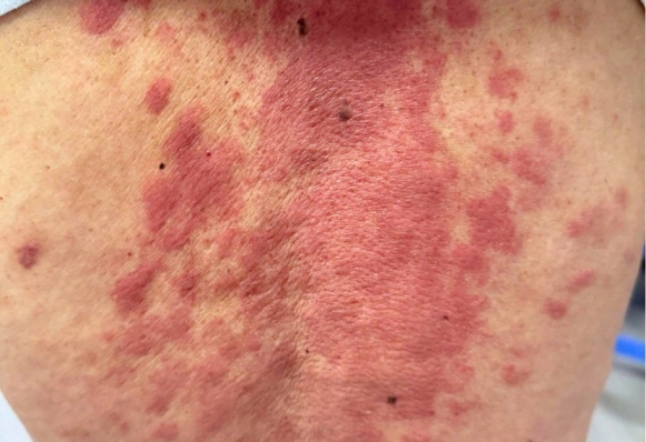 Những điều cần biết về U lympho da