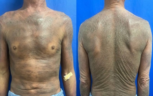 Phản ứng da do thuốc kháng Lao