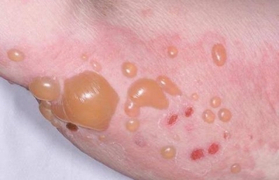 Chăm sóc người bệnh Pemphigoid bọng nước
