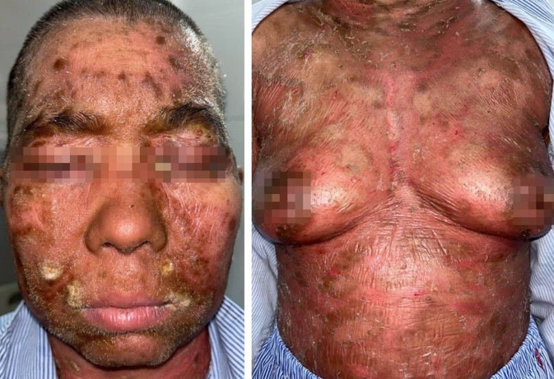 Hình 3: tổn thương của bệnh nhân ở lần nhập viện thứ 2: Sẩn đỏ mảng đỏ thẫm màu, bề mặt có vảy trắng dày lan tỏa mặt tay chân thân mình, một số tổn thương đóng có mủ, trợt ướt tai, tay chân