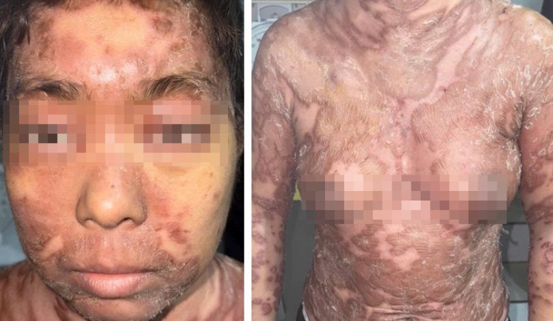 Hình 1: tổn thương của bệnh nhân ở lần nhập viện đầu tiên: tổn thương cơ bản là dát đỏ bong vảy ranh giới rõ, tập trung thành mảng phân bố khắp tay chân thân mình.