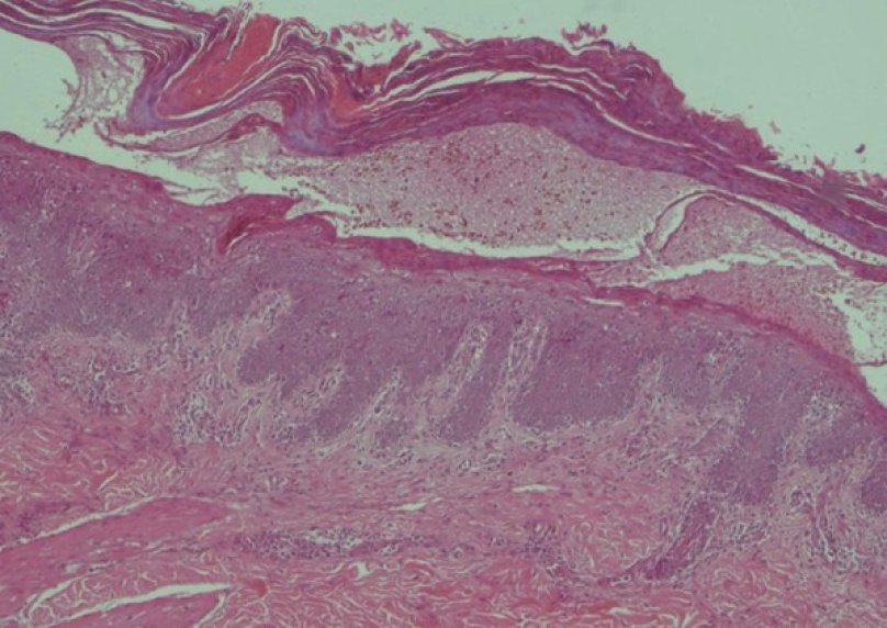 Hình 2: mô bệnh học lần 1: Viêm quá sản thượng bì dạng vảy nến có nhiều tế bào dị sừng