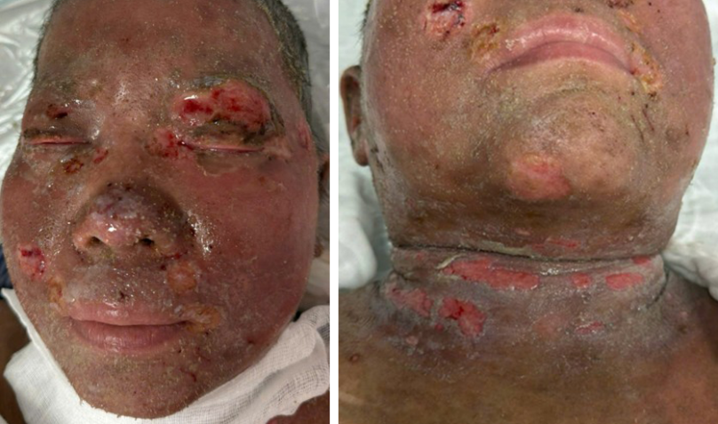 Hình 5: Hình ảnh tổn thương của bệnh nhân lúc có biến chứng nặng: Eczema herpesticum/nhiễm khuẩn huyết