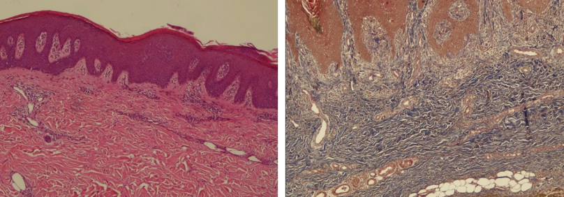 Hình 7: Thượng bì quá sản dạng vảy nến, dày sừng và á sừng. Viêm phản ứng dạng lichen và tăng sinh collagen. Xuất hiện nhiều tế bào dị sừng (dyskeratotic cells) nằm rải rác trong lớp gai thượng bì. Nhuộm Masson 3 màu xác nhận tình trạng tăng sinh collagen lan tỏa tại trung bì.