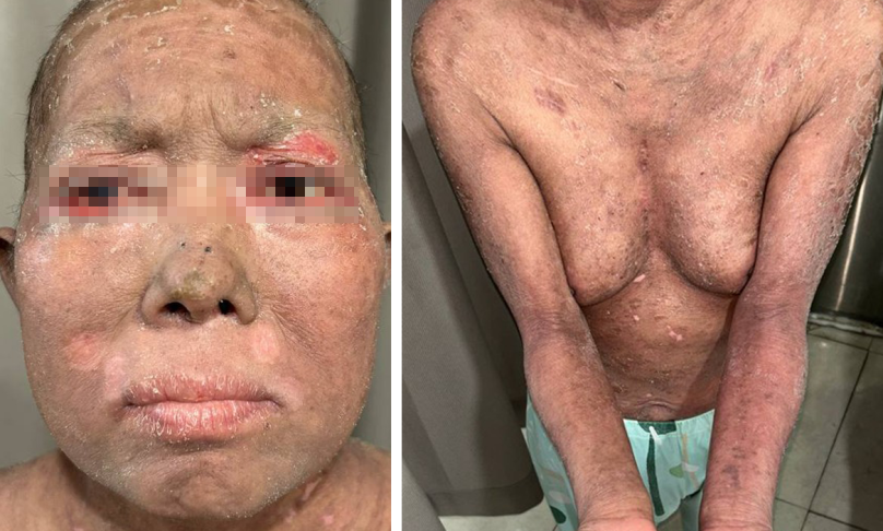 Hình 6: Hình ảnh tổn thương của bệnh nhân ở lần nhập viện thứ 3: dát đỏ bong vảy toàn thân, có lộn mi mắt. 1 số tổn thương dày da lichen hóa ở tay chân.