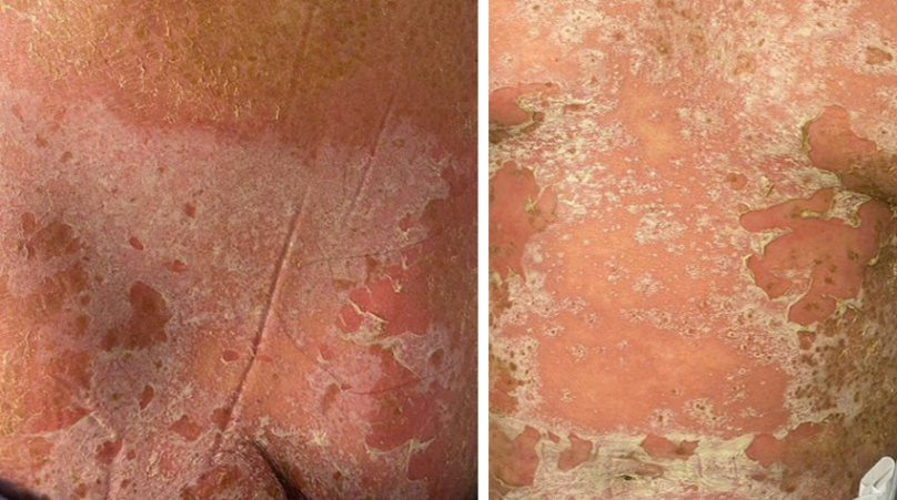 Tổn thương da của bệnh nhân Vảy nến mủ toàn thân