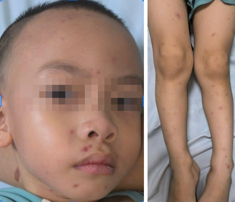 Hình 2: Tổn thương mụn nước lõm giữa đồng đều rải rác cả đầu, mặt, chân