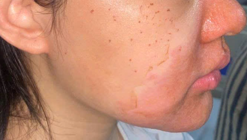 Tổn thương trên da bệnh nhân sau khi peel da tại cơ sở spa