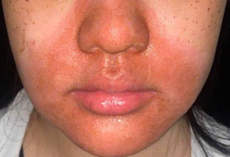 Tổn thương trên da bệnh nhân sau khi peel da tại cơ sở spa