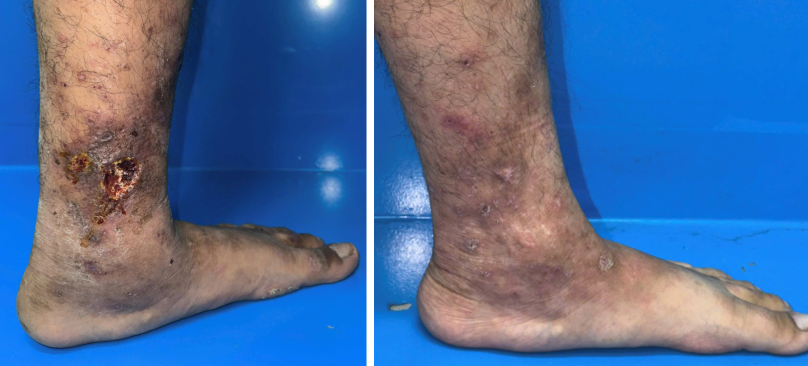 Tổn thơng loét mạn tính do mạch máu được điều trị ổn định