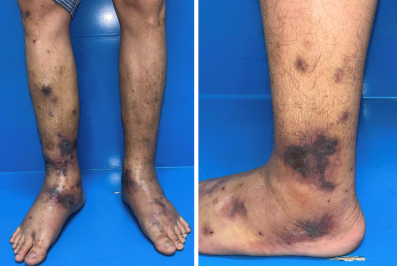 Ca bệnh viêm mạch EGPA đầu tiên được chẩn đoán trong chuyên ngành Da liễu tại Việt Nam
