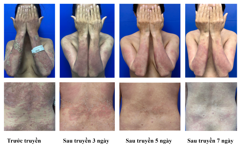 Hình ảnh bệnh nhân trước sau 3,5, 7 ngày điều trị
