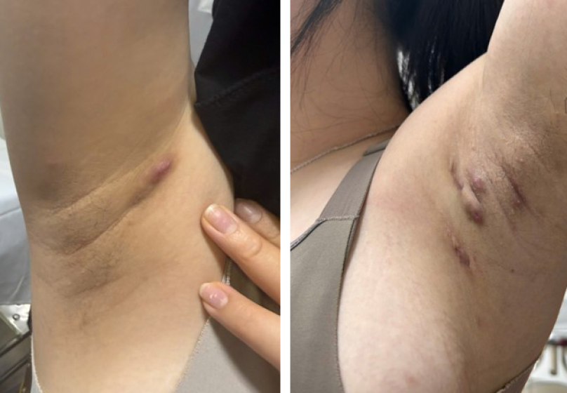 Hình 1. Tổn thương sớm ở vùng nách: nốt sưng đau hoặc ổ áp xe đơn độc, dễ nhầm với mụn nhọt