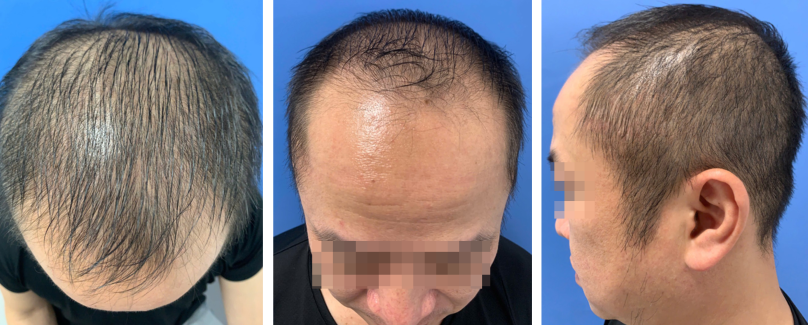 Hình 1: Tổn thương bệnh nhân rụng tóc androgen: A.Sợi tóc thu nhỏ, mảnh hơn, mật độ tóc thưa làm lộ da đầu vùng đỉnh và trán. B,C. Đường chân tóc vùng trán có xu hướng rút lui về phía sau (tạo hình chữ M rõ). Nguồn: Phòng khám rụng tóc thể mảng và bệnh lý tóc, Bệnh viện da liễu Trung Ương.