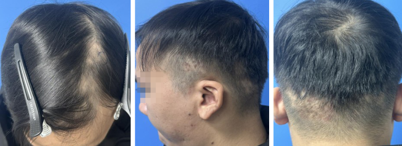 Hình 1;2;3: Tổn thương nhiều mảng rụng tóc ranh giới không rõ, đỏ da nhẹ tại vùng rụng. Một số tổn thương dát tăng sắc tố rải rác vùng tóc rụng - Nguồn: Nhóm chuyên môn Bệnh rụng tóc thể mảng và bệnh lý tóc- Bệnh viện Da liễu Trung ương