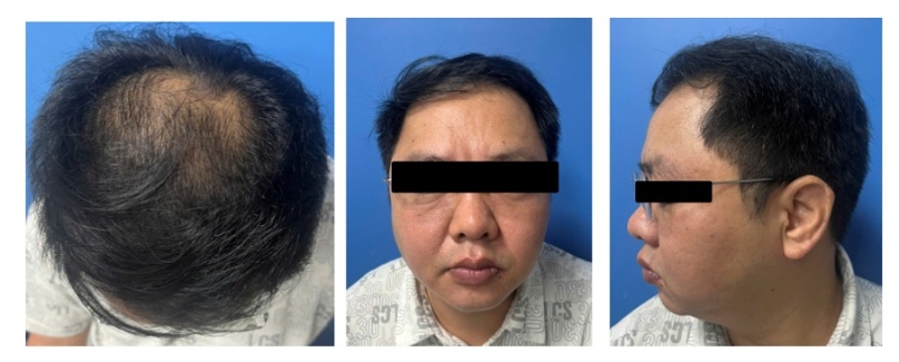 Hình 3: Bệnh nhân số 1, sau điều trị 5 tháng bằng Finasteride 1mg/ ngày(Nguồn: Phòng khám rụng tóc thể mảng và bệnh lý tóc, bệnh viện Da liễu Trung Ương)