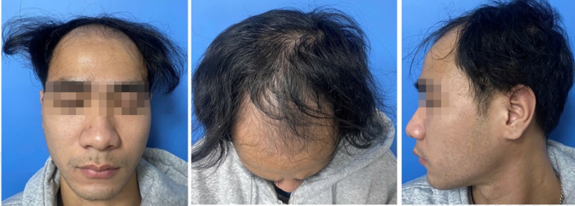 Hình 4: Bệnh nhân số 2, nam 24 tuổi, rụng tóc androgen khoảng 5 năm nay, ảnh trước khi điều trị (Nguồn: Phòng khám rụng tóc thể mảng và bệnh lý tóc, bệnh viện Da liễu Trung Ương