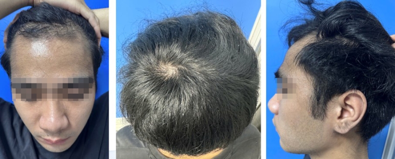 Hình 5: Bệnh nhân số 2, sau điều trị 5 tháng bằng Finasteride 1mg/ ngày(Nguồn: Phòng khám rụng tóc thể mảng và bệnh lý tóc, bệnh viện Da liễu Trung Ương)