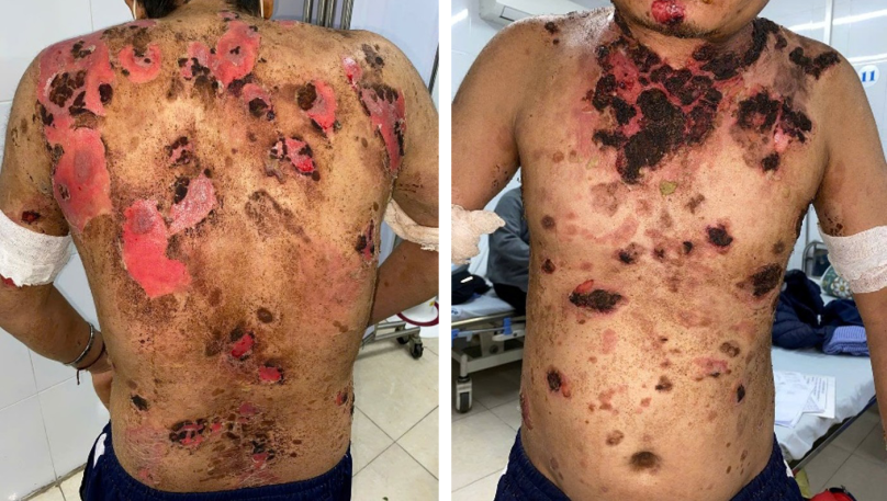 Hình 2. Tổn thương da trước truyền rituximab.