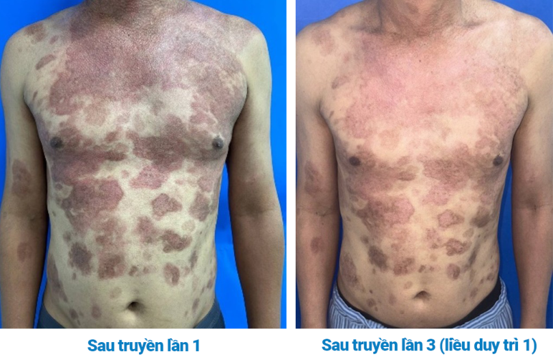 Hình 3. Diễn tiến tổn thương sau điều trị rituximab