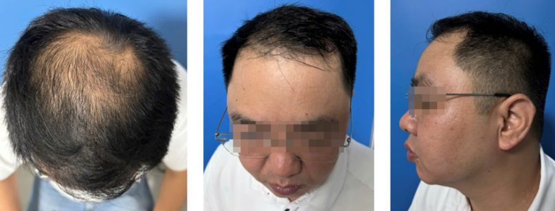 Hình 2: Bệnh nhân số 1, nam 34 tuổi, rụng tóc androgen nhiều năm, ảnh trước khi điều trị (Nguồn: Phòng khám rụng tóc thể mảng và bệnh lý tóc, bệnh viện Da liễu Trung Ương)