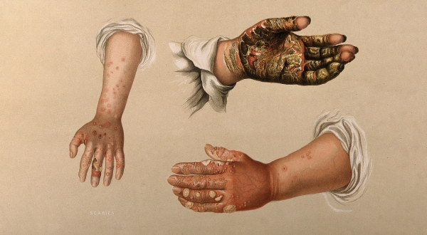 Bệnh ghẻ: Hiểu đúng để điều trị dứt điểm và không tái phát