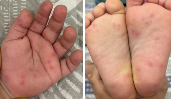 Bệnh tay chân miệng: Nguyên nhân, dấu hiệu nhận biết và phương pháp điều trị