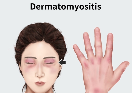 Các tự kháng thể trong viêm da cơ và mối liên quan với các tổn thương lâm sàng