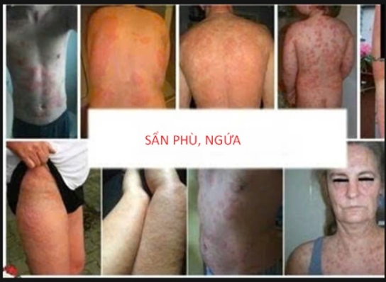 Hơn hai mươi năm tự dùng thuốc điều trị bệnh Mày đay - Cảnh báo nguy cơ tiềm ẩn cho sức khỏe người bệnh