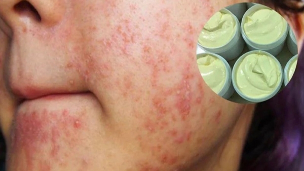 Laser và ánh sáng: Giải pháp cho trứng cá đỏ do kem trộn