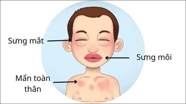 Mày đay mạn tính kèm phù mạch nặng: Nhận biết các triệu chứng cần điều trị cấp cứu