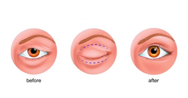 Nâng Cung Mày: Giải Pháp Tái Trẻ Hóa Vùng Mắt Tự Nhiên, An Toàn