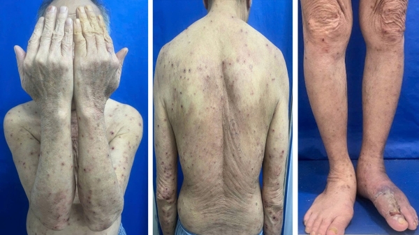 Sẩn ngứa kéo dài ở người cao tuổi: Đừng bỏ qua bệnh da bọng nước tự miễn