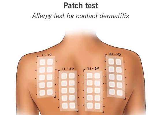 Vai trò của test áp trong chẩn đoán viêm da tiếp xúc