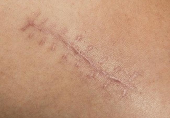 Sẹo sau phẫu thuật: nên can thiệp sớm hay chờ đợi?
