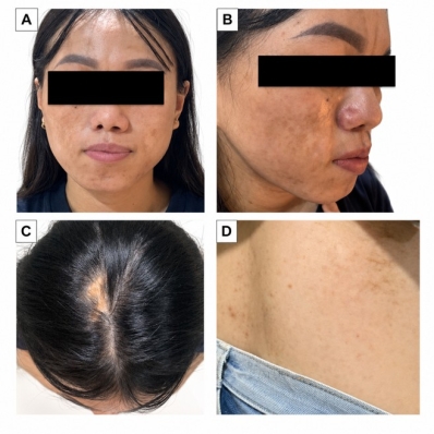 Xơ cứng bì khu trú và hội chứng Parry-Romberg: hai biểu hiện trong cùng một phổ bệnh?