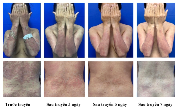 Đáp ứng lâm sàng nhanh với spesolimab ở bệnh nhân vảy nến thể mủ toàn thân đợt cấp: báo cáo ca bệnh tại Bệnh viện Da liễu Trung ương