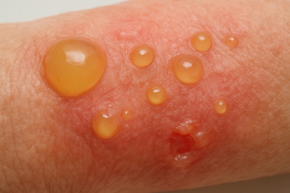 Thuốc sinh học trong điều trị Pemphigoid bọng nước