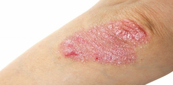 Chăm sóc người bệnh vảy nến: Những điều cần biết để kiểm soát bệnh hiệu quả