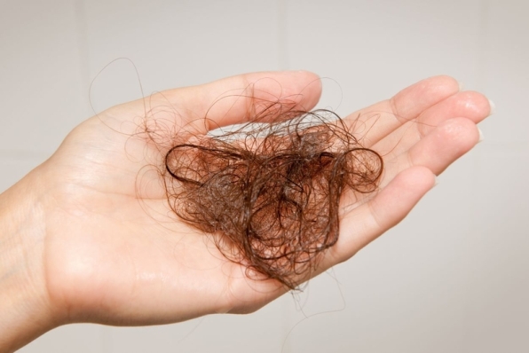 Chẩn đoán và chẩn đoán phân biệt rụng tóc từng mảng (Alopecia areata)
