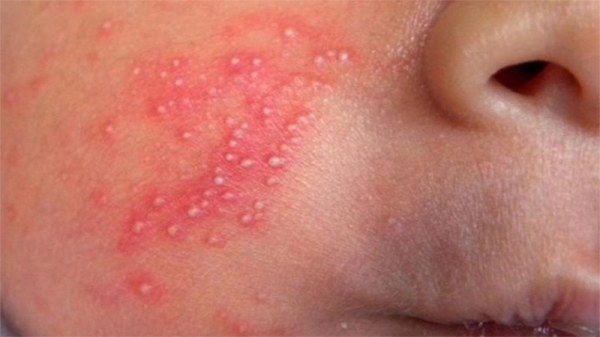 Trứng cá trẻ sơ sinh: hiểu đúng để chăm sóc đúng