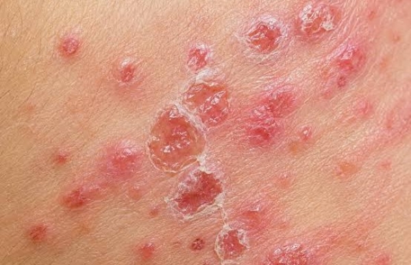 Yếu tố tiên lượng tái phát trong bệnh Pemphigus thông thường